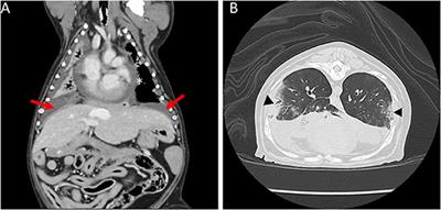 Case Report: Septic Pericarditis With Achromobacter xyloxidans in an Immunosuppressed Dog